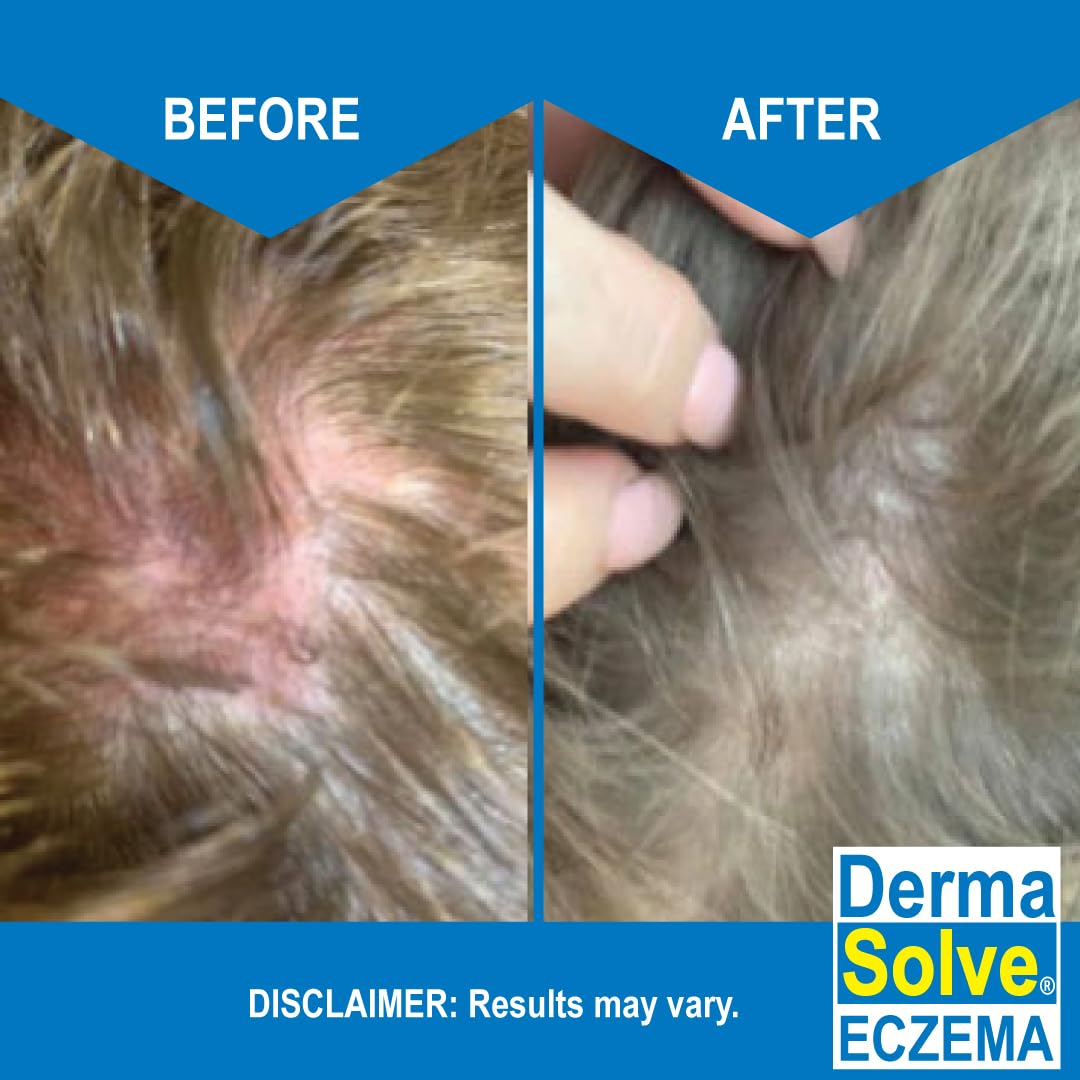 Eczema Shampoo & Conditioner (Combo Pack) - Flare Control Scalp & flake Relief Therapy that Protects, Moisturizes, and Repairs Skin by DermaSolve - Kids & Adults - Steroid Free